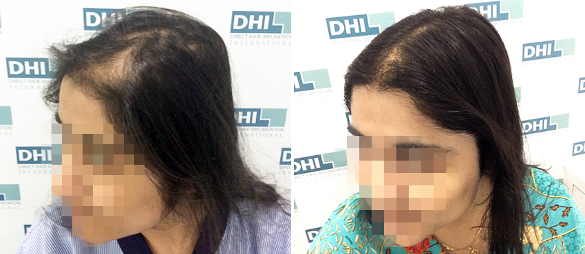 DHI before & after hair transplant results